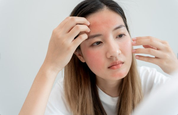 What is a sun rash?