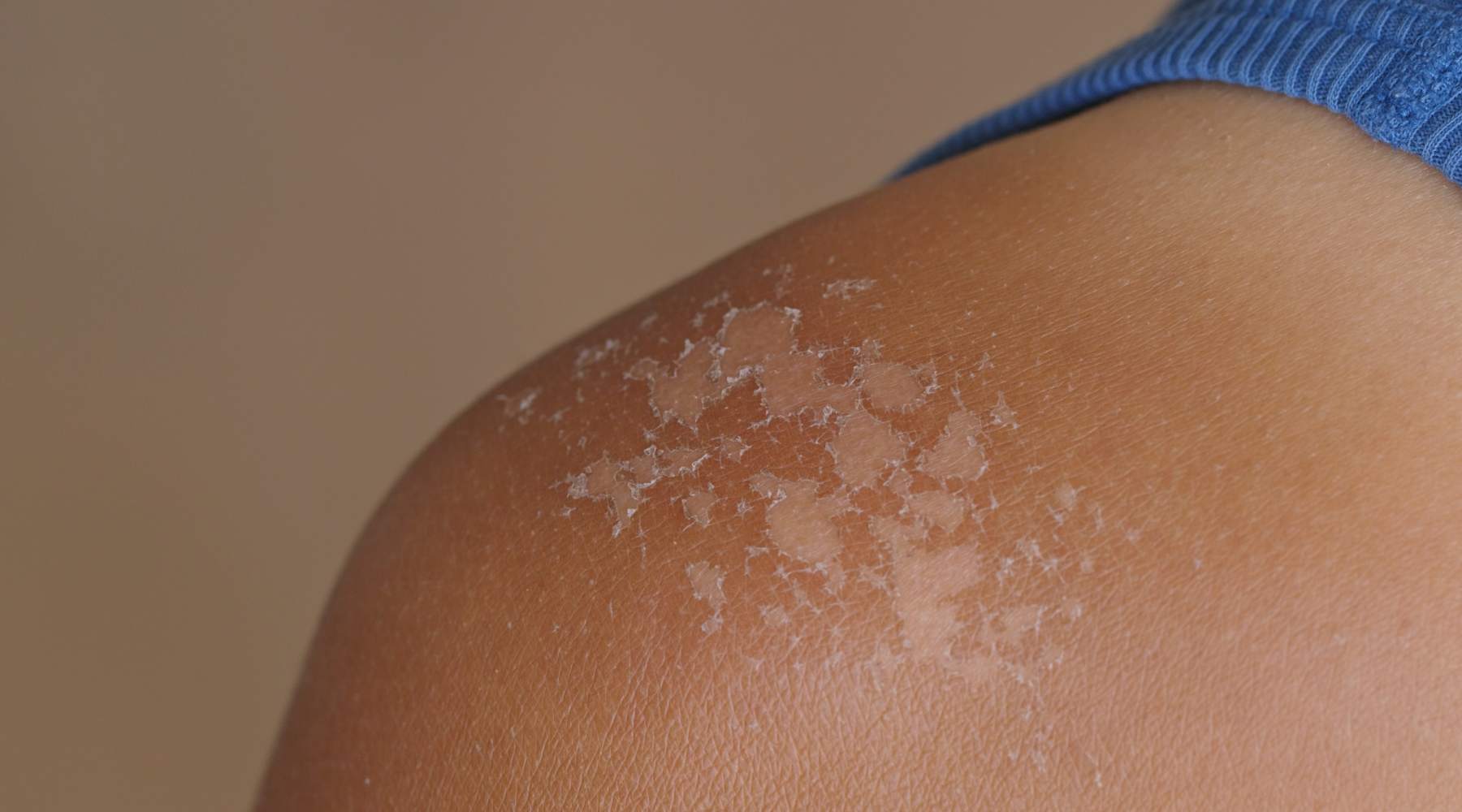Sunburned shoulder with sun blisters—How to get rid of sun blisters
