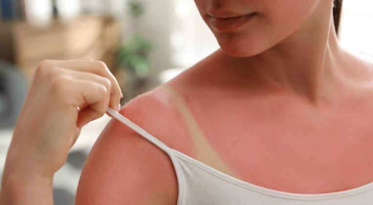 Woman with sunburned skin—Sunburn safety: All you need to know to stay safe in the sun