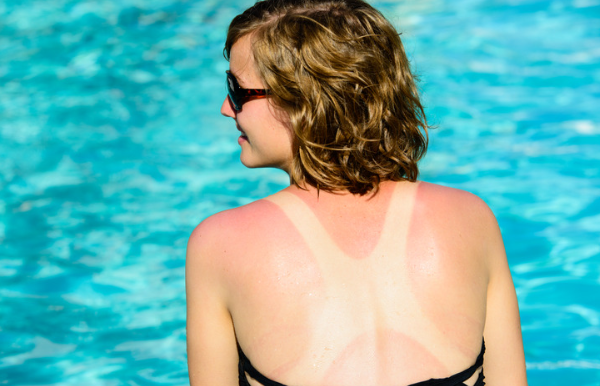 Sun poisoning vs. sunburn