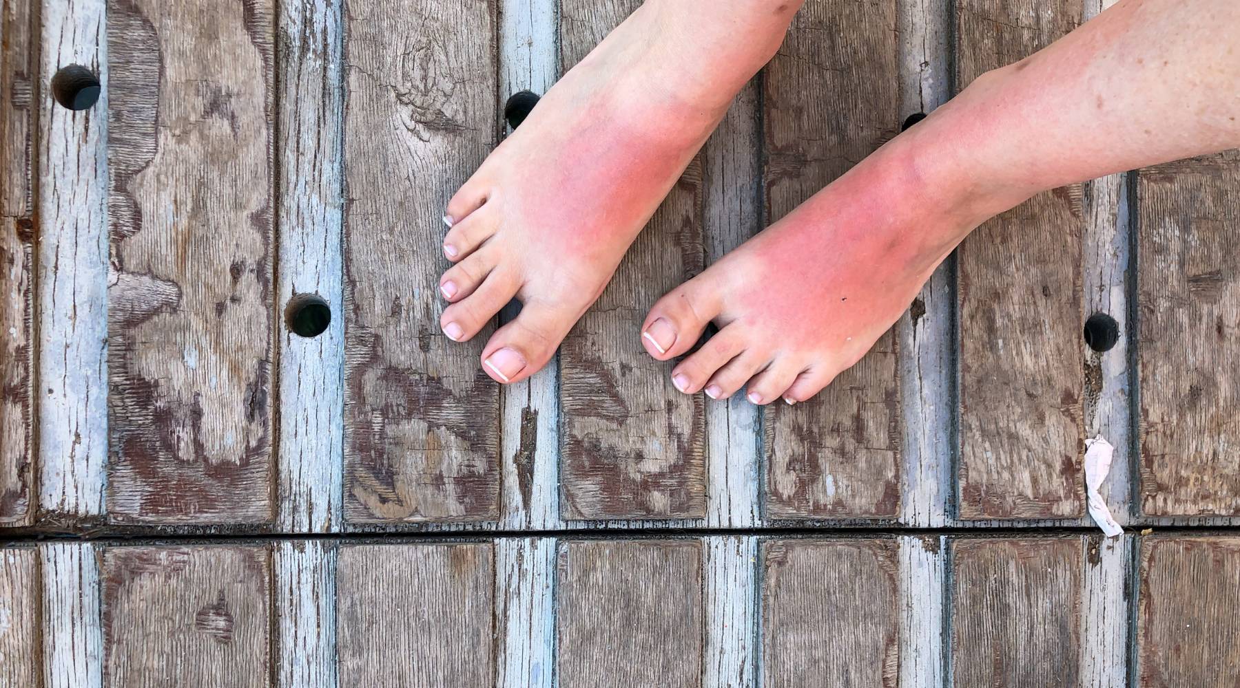 What is sun poisoning? Causes, symptoms, and treatment
